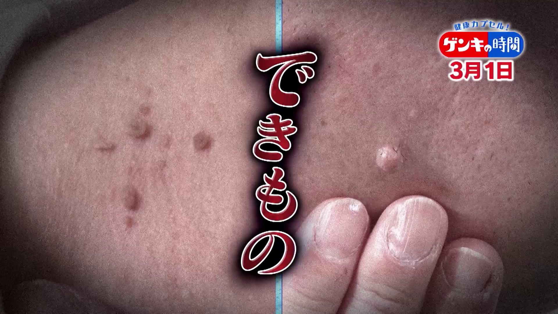 「悪性のできもの」見分けるポイント…「皮膚の変化」見逃すと危険！専門医に学ぶ！“悪性のできもの”のサイン