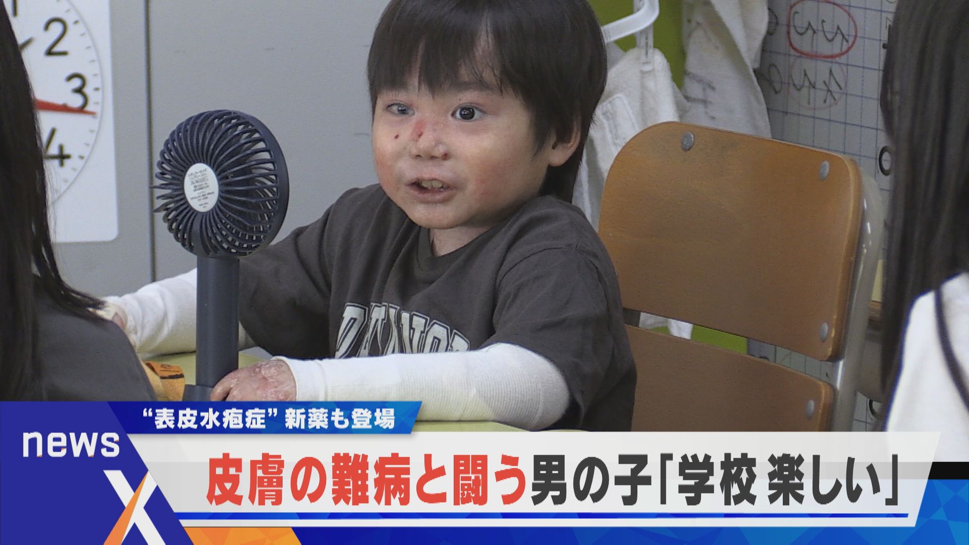 難病・表皮水疱症と闘う男の子 病気と向き合い成長「学校、楽しい」【newsX】