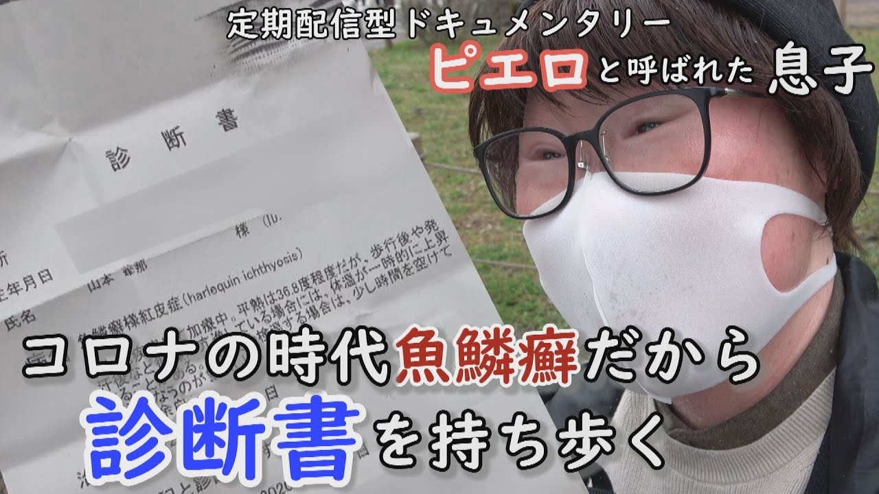 歩くだけで３９℃の発熱…落ちる皮膚に悩んだ修学旅行とは！？魚鱗癬の大学生に密着 　CBCテレビ定期配信型ドキュメンタリー「ピエロと呼ばれた息子」第３９話