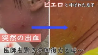 傷つきやすいけど、治りやすい…賀久くんの皮膚に医師も驚き～CBCテレビ定期配信型ドキュメンタリー「ピエロと呼ばれた息子」第５６話
