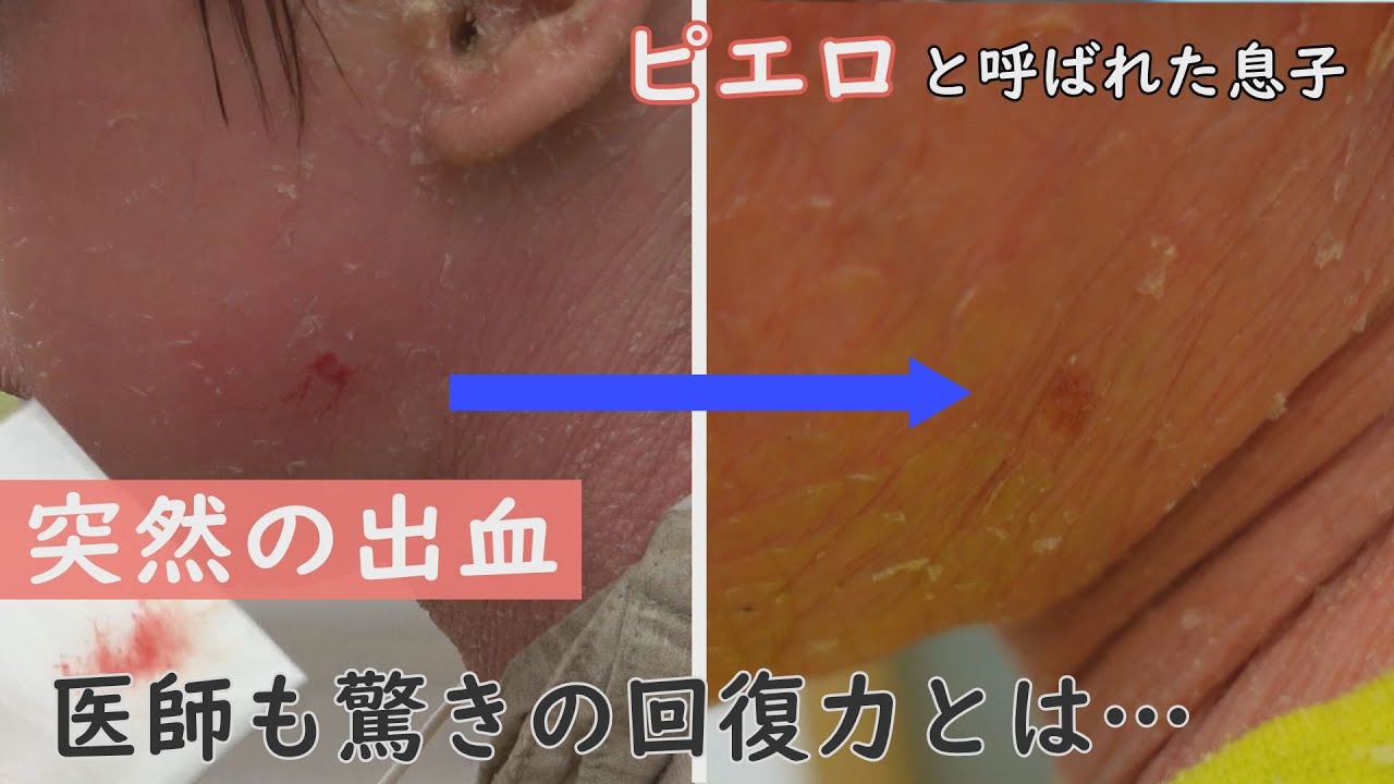 傷つきやすいけど、治りやすい…賀久くんの皮膚に医師も驚き～CBCテレビ定期配信型ドキュメンタリー「ピエロと呼ばれた息子」第５６話