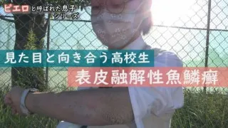 手のひら・足裏の皮膚だけ正常な“魚鱗癬”…学校生活は？表皮融解性魚鱗癬～定期配信型ドキュメンタリー「ピエロと呼ばれた息子」第７３話